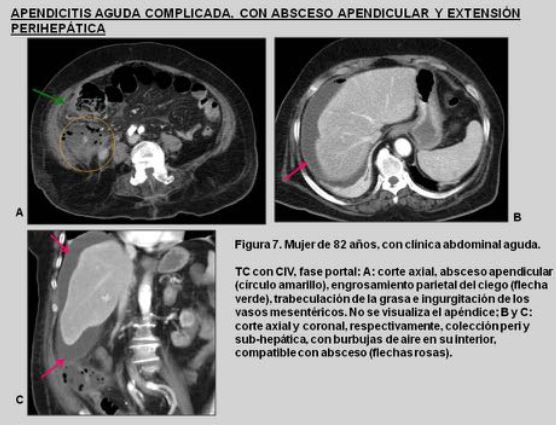abdominal cancer vancer apendicular diagnostico y tratamiento medicament deparazitare umana